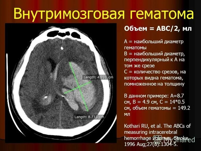 Кт внутримозговая гематома головного мозга. Субдуральная гематома гематома на кт головного мозга. Стадии внутримозговой гематомы. Объем внутримозговой гематомы. Очаговые изменения желудочка