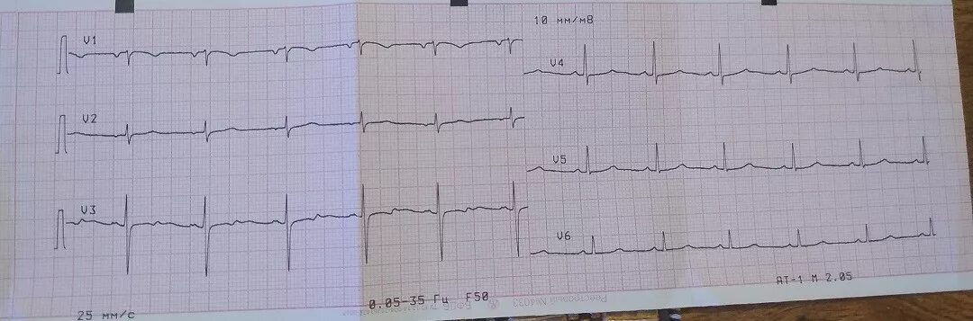 Диффузные изменения экг что это значит. Диффузные изменения миокарда на ЭКГ. Диффузное поражение миокарда ЭКГ. ЭКГ при диффузных изменениях миокарда. Диффузные изменения миокарда ЭКГ критерии.