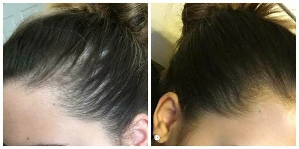 Как остановить выпадение волос после. Выпадение волос до и после.