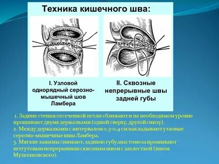 Кишечные швы топографическая анатомия