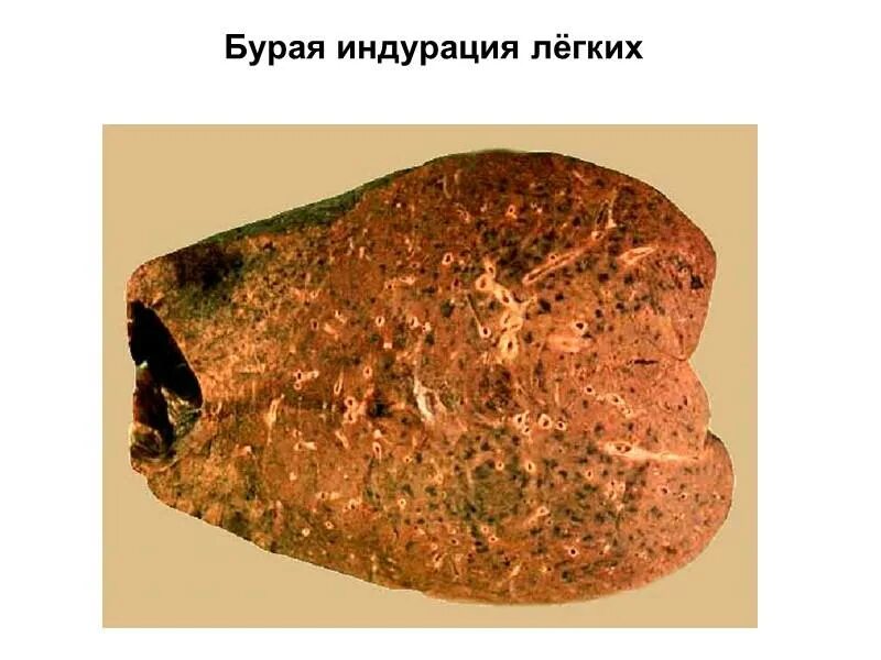 Бурая атрофия печени макропрепарат. Бурая индурация легких макропрепарат. Бурая индурация легких патанатомия. Бурая индурация легких морфогенез. Бурая индурация легких патанатомия патогенез.