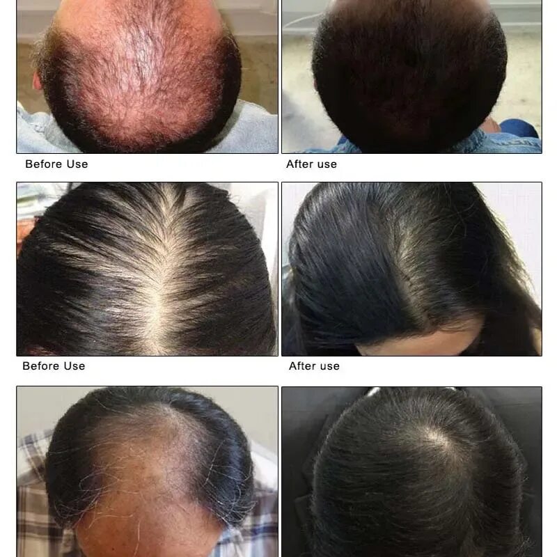 Восстановление выпадения волос. Рост волос на голове. Для роста волос. Средство для отрастания волос. Стимуляция роста волос на голове.