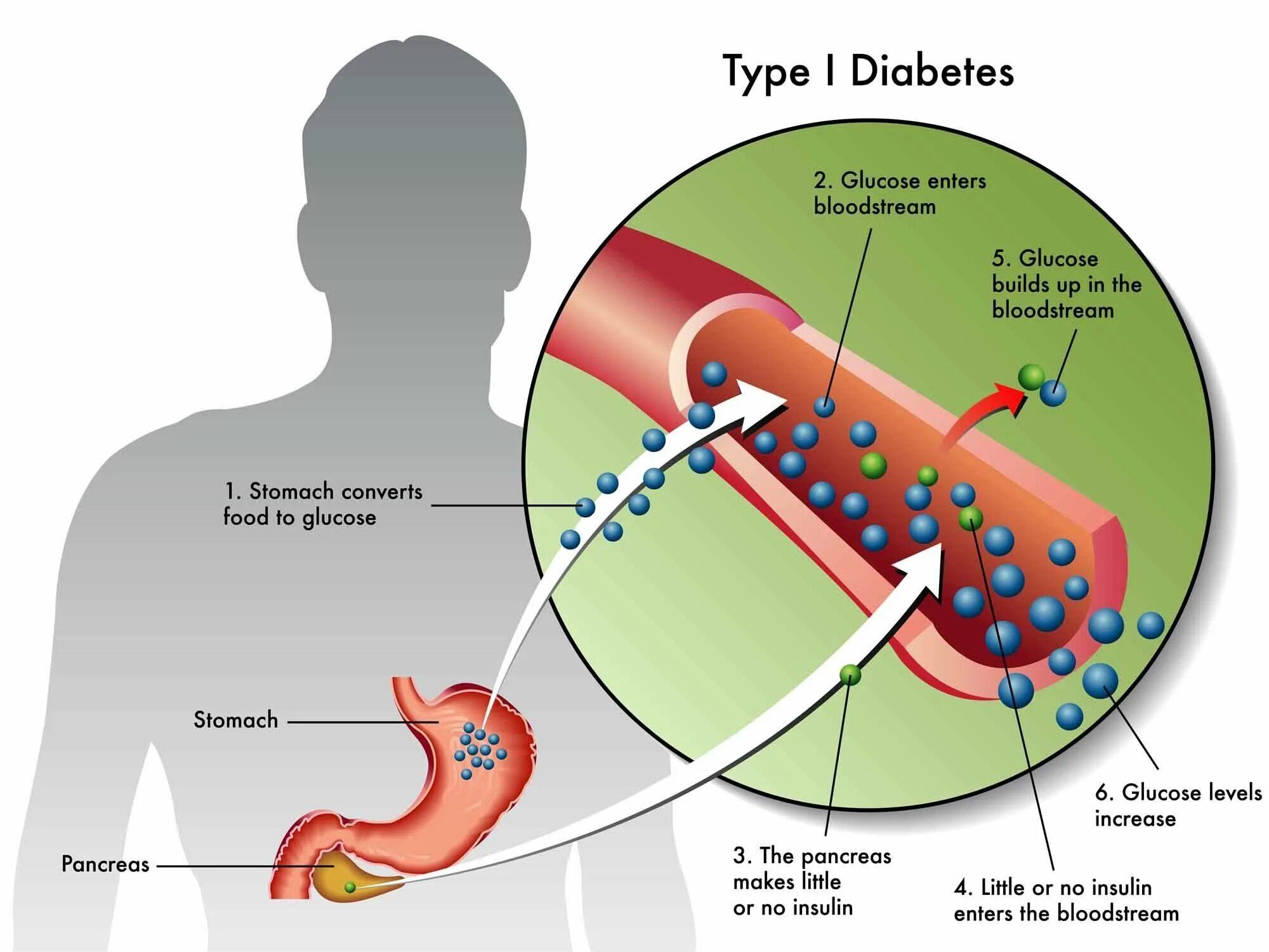 Сахарный диабет 1-го типа. Сахарный диабет 2-го типа. Типы сахарного диабета 1 типа. Инсулинорезистентность клетки. Диабет зависимый сахарный