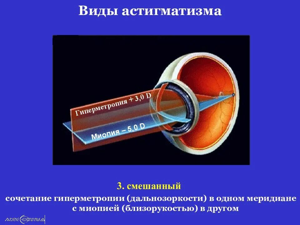Ли вылечить астигматизм. Миопический астигматизм классификация. смешанный астигматизм скиаскопия. простой и сложный астигматизм. смешанный гиперметропический астигматизм.