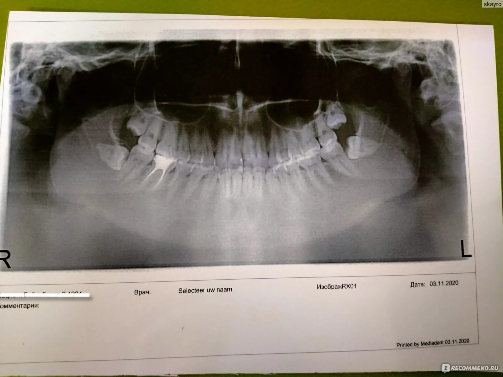 Снимок зубов видное. Зуб мудрости на снимке рентгена. Рентген удаленного зуба. Видно ли на рентгене гной в зубе.
