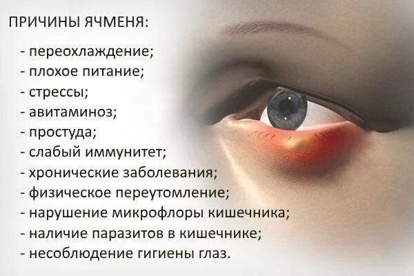От чего появляется причина. Ячмень на глазу причины появления. причина ячменяня на глазу. причины появления ячменя.