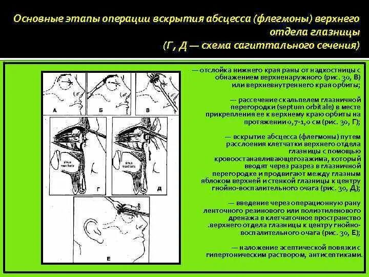После вскрытия абсцесса накладывают повязку с. Показания к вскрытию абсцесса. После вскрытия абсцесса накладывают повязку с мазью. Ретрофарингеальный абсцесс вскрытие. После вскрытия абсцесса накладывают повязку с.