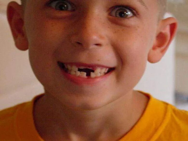 можно ли ходить без зуба