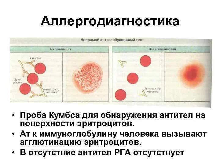 Определение антител к эритроцитам. Реакция кумбса при гемолитической анемии. антитела на поверхности эритроцитов. пробы для обнаружения антите.