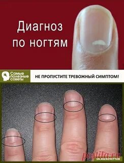 Ногти болезнь какая болезнь