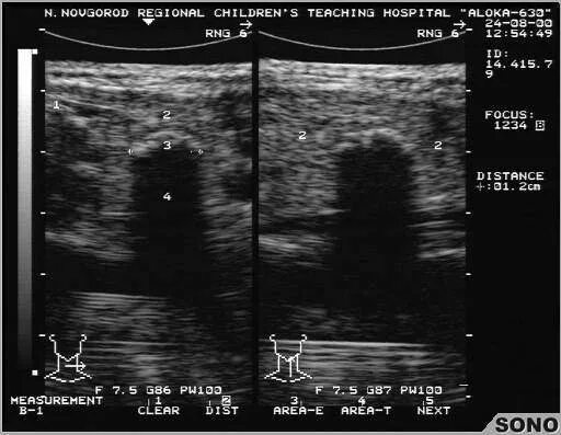 тестикулярный микролитиаз узи. микрокальциноз яичек на узи. микрокальцинаты узи. микрокальцинаты узи. кальцинат молочной железы на узи.