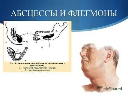 В чем отличие флегмоны от абсцесса