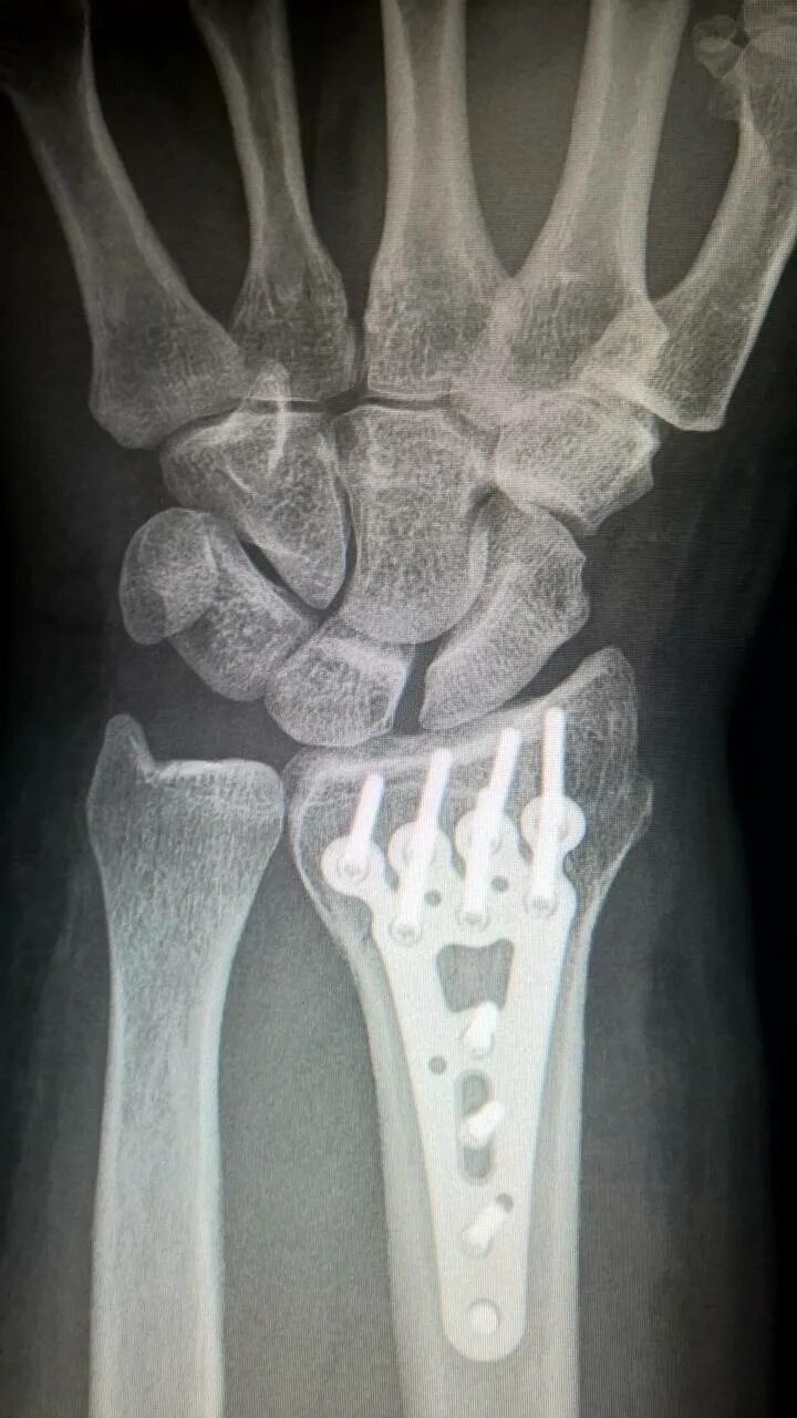 Титановая пластина на рентгене. Трещина лучевой кости рентген. Рентгенограмма перелом кости.