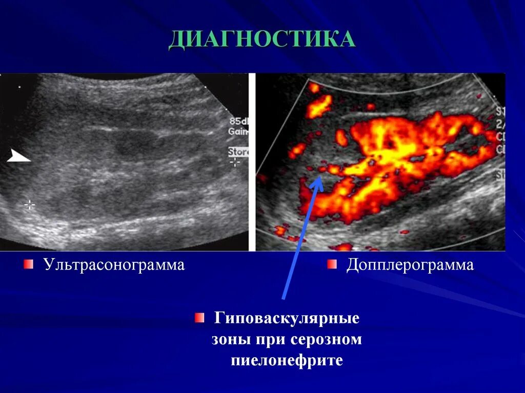 Гиповаскулярное образование в печени. Допплерограмма. Ультрасонограмма почки. Ультрасонограмма печени. Гиповаскулярной зоны печени s2.