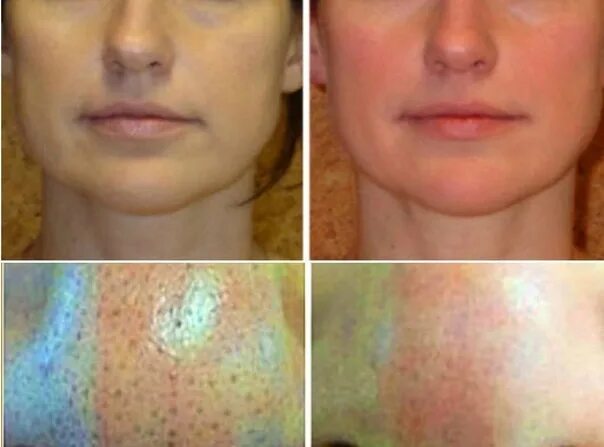 Ultrasonic face peeling - Lux Medicus