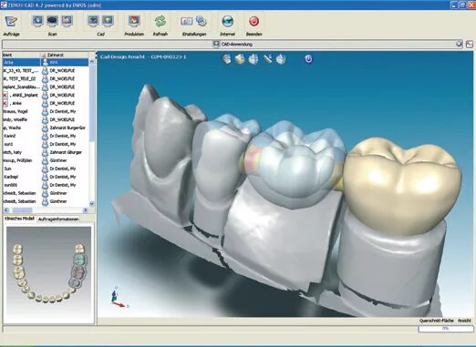 Cad cam моделирование. Фрезерование коронок cad cam. cam/cad моделирование протезов. кад кам технологии в стоматологии.