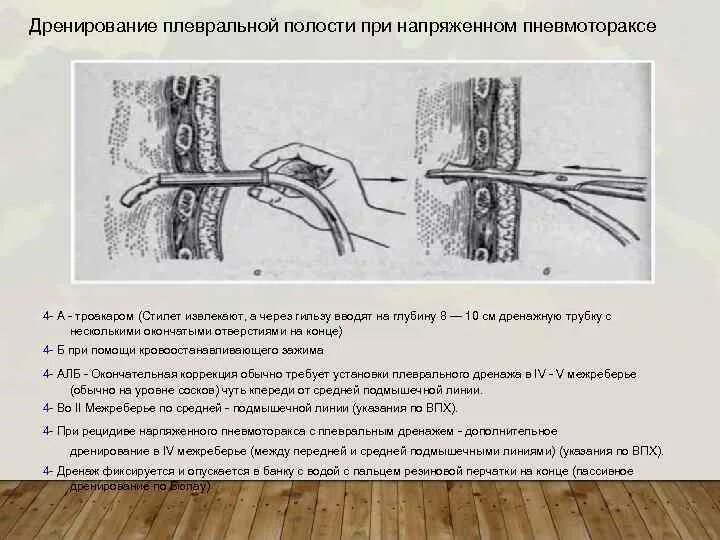 Лечение плевральной полости. Методика дренирования плевральной полости. Методика пункции плевральной полости. Дренаж плевральной полости по Бюлау. Трехбаночное дренирование.