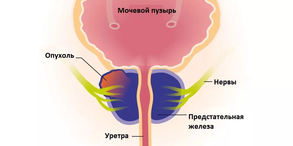 Везикулит у мужчин симптомы. Предстательная железа где. Простата у девушек признаки.