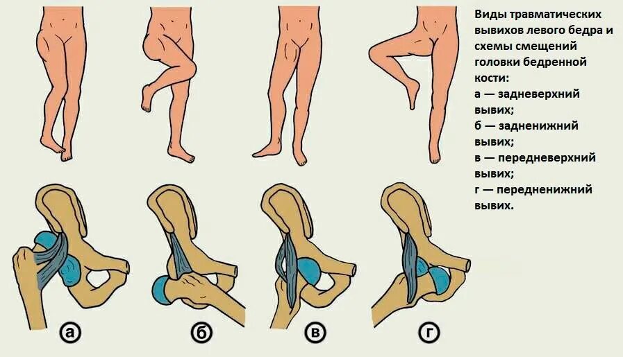 Подвывих тазобедренного сустава классификация. Вывих тазобедренного сустава. Передненижний вывих бедра. Врожденный вывих бедра классификация.