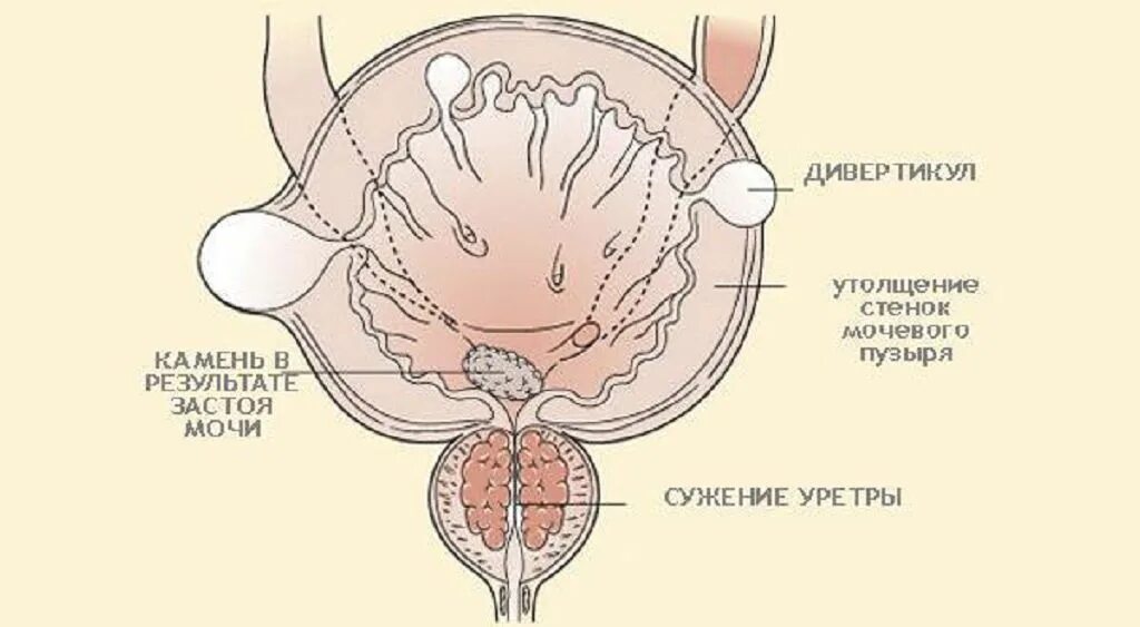 Утолщение мочевого пузыря у мужчин. Псевдодивертикул мочевого пузыря. Дивертикул стенки мочевого пузыря. Шейка дивертикула мочевого пузыря. Выпячивание стенки мочевого пузыря.