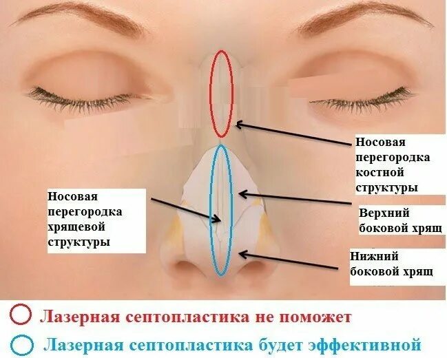 Лазерная септопластика носовой перегородки. Исправление перегородки. Исправление искривления перегородки носа. Операция на носовую перегородку. Операция по восстановлению перегородки