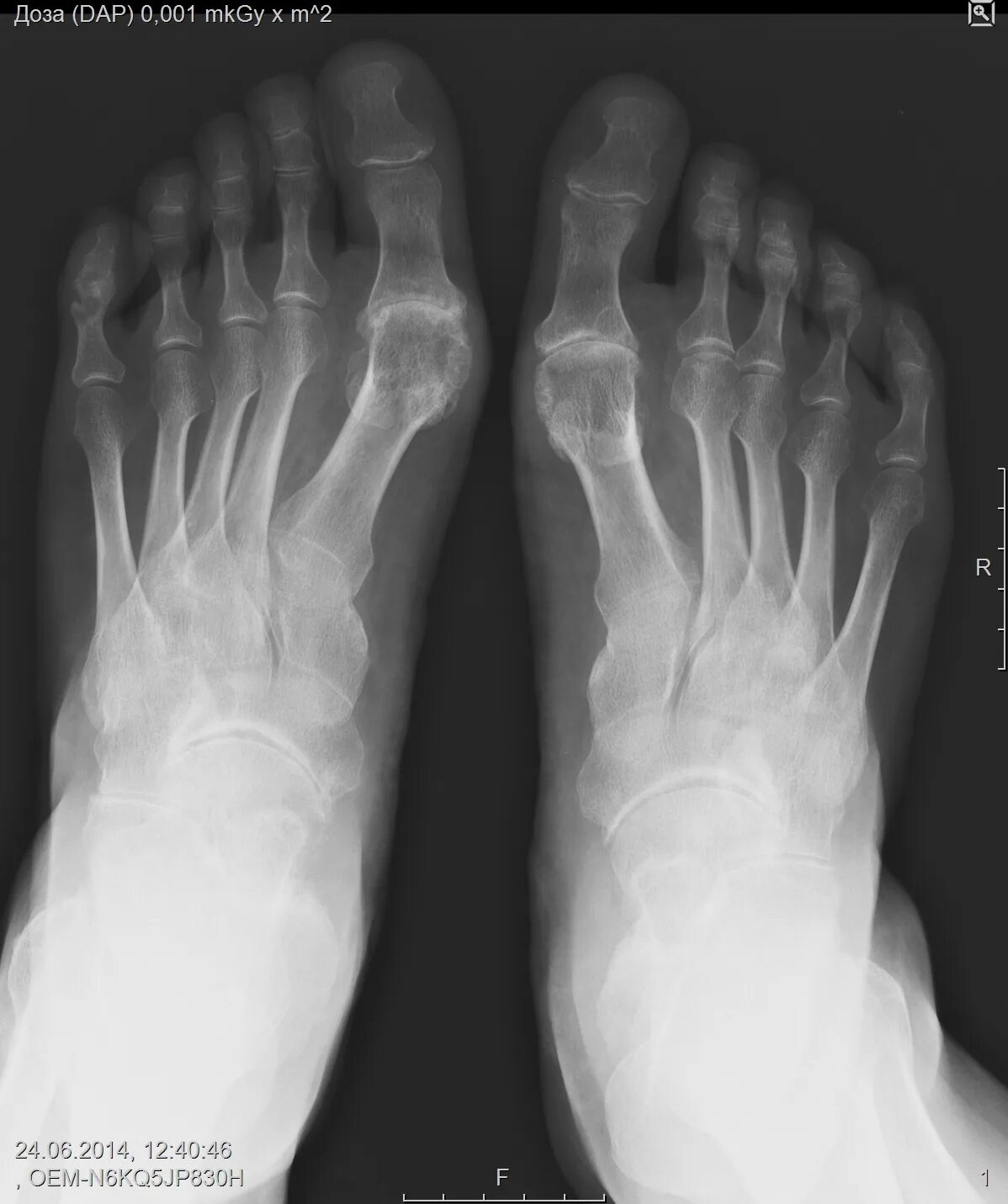 Подагра рентгенологические стадии. Тофусная подагра стопы рентген. Подагрический артрит рентген. Подагрический артрит рентген. Тофусы рентген.