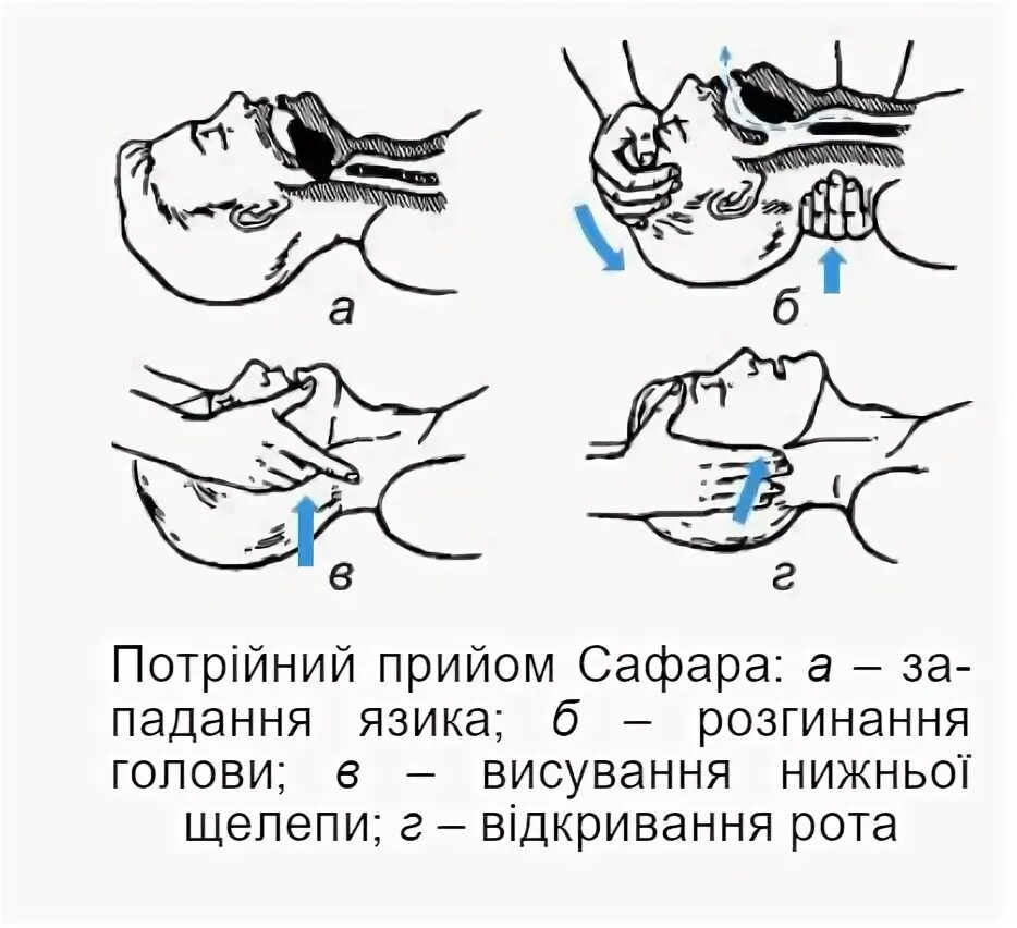 Тройной прием алгоритм