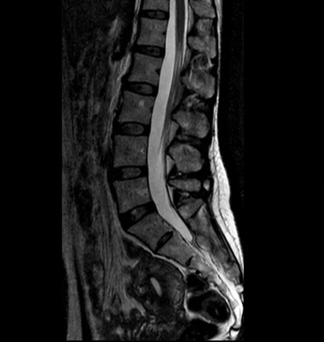 Мрт пояснично-крестцового отдела позвоночника. Мрт позвоночника пояснично-крестцового отдела (l1-s1). Кт грудного и пояснично крестцового отдела позвоночника. Мрт спинного мозга.