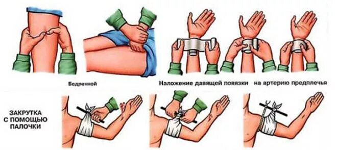 Способы остановки кровотечения наложение давящей повязки. Остановка кровотечения наложением давящей повязки. остановка венозного кровотечения наложение повязки давящей. перевязка для остановки кровотечения. наложение повязки при кровотечении алгоритм.