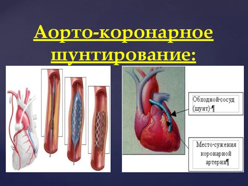 Шунтирование коронарных артерий. Коронарное стентирование сосудов сердца. Аортокоронарное шунтирование (АКШ). Шунтирование сосудов сердца стент. Операция шунтирование артерии