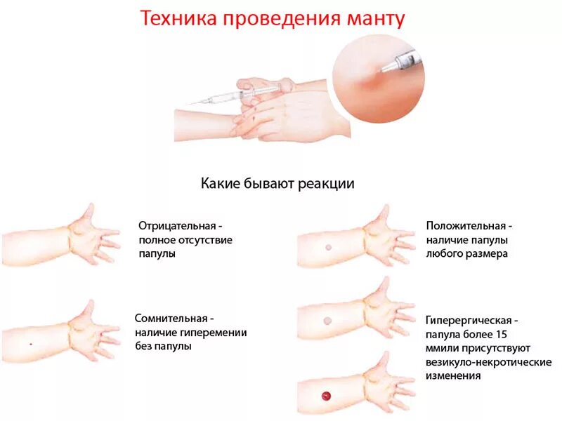 Диаскинтест в школе обязателен или нет