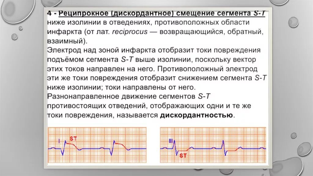 Инфаркт миокарда ЭКГ реципрокные изменения. Дискордантные изменения на ЭКГ. Реципрокные изменения на ЭКГ при инфаркте. Реципрокность при инфаркте миокарда. Отведение v1 на экг