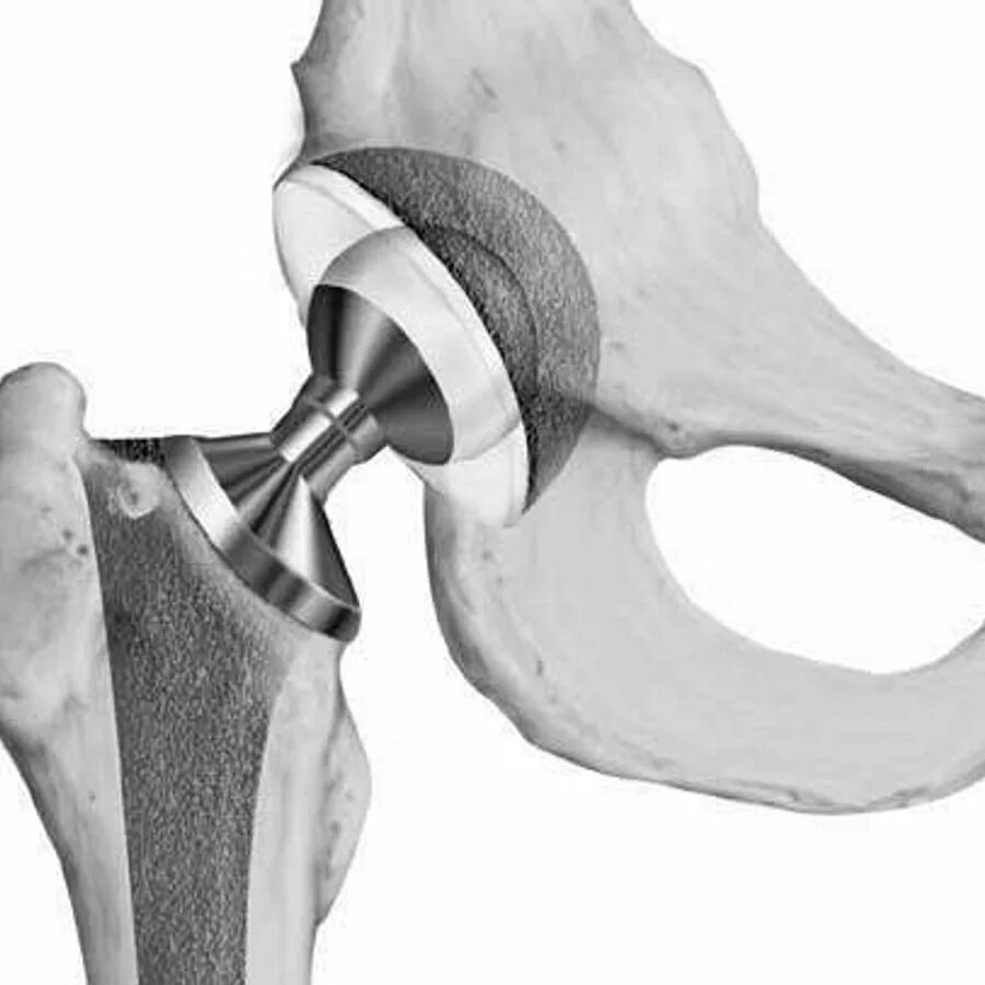 Биполярный эндопротез тазобедренного сустава. Спейсер тазобедренного сустава. Тотальный эндопротез тазобедренного сустава Сиваша. Цементная чашка эндопротеза тазобедренного сустава. Как происходит операция по замене тазобедренного сустава