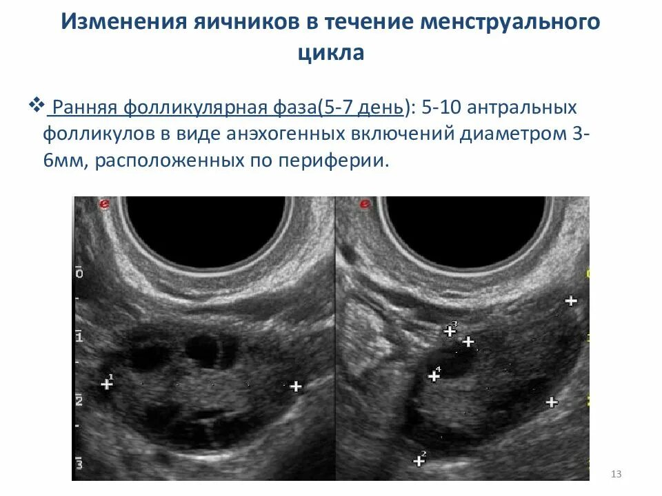 Находится в фолликуле. Фолликулы по периферии яичника что это. Норма фолликулов. Фолликул в яичнике на 5 день цикла.