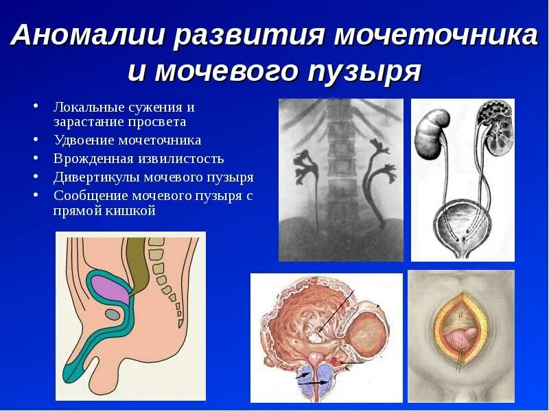 Развитие мочеточников. Врожденная патология мочеточника. Аномалии развития мочеточников и мочевого пузыря. Пороки развития мочеточника.