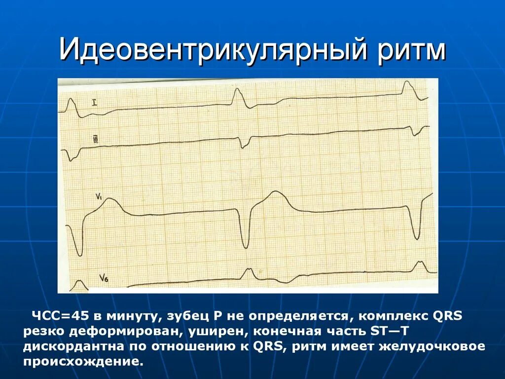 Деформированный зубец р. Деформированный комплекс qrs на экг. уширенный деформированный комплекс qrs на экг. желудочковый комплекс qrs. деформация комплекса qrs.