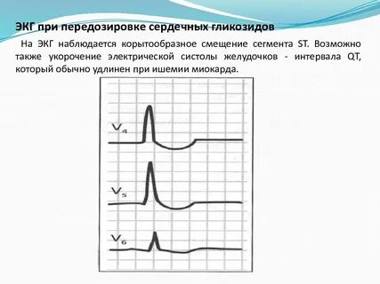 Интоксикация на экг