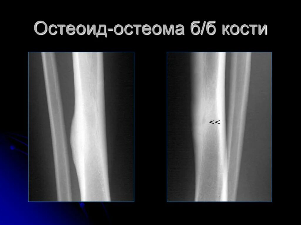 Остеома бедренной кости рентген. Опухоли большеберцовой кости остеома. Признаки остеомы. Остеоид-остеома бедренной кости рентген. Компактная остеома большеберцовой кости.