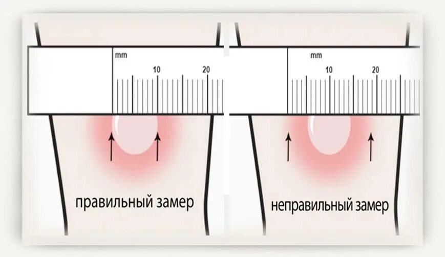 Туберкулиновая проба норма. Нормы размеров папулы манту у детей. Размер прививки манту норма у детей 5 лет. Реакция манту Размеры норма у ребенка 7 лет. Реакция манту норма у детей 10 лет.