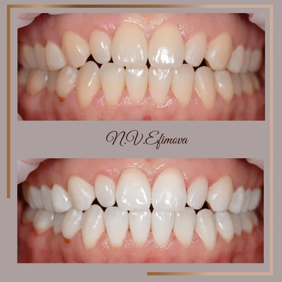 Отбеливание опалесценс буст. Белоснежная улыбка. Отбеливание калининград. Линия улыбки. Красивые зубы.