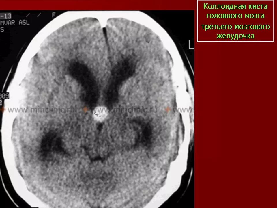 Киста желудочка головного мозга. Коллоидная киста 3 желудочка головного мозга. Обызвествленные опухоли головного мозга кт. Коллоидная киста мозга кт. Коллоидная киста третьего желудочка на кт.