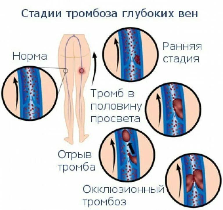 Как найти тромб. Стадии развития тромбоза.