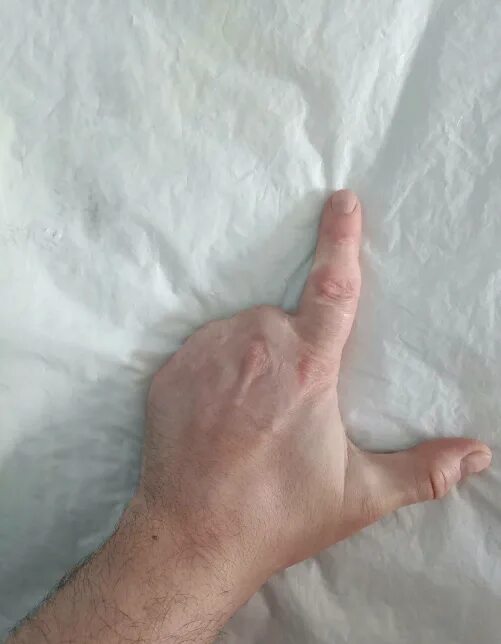 Инвалидность пальцев руки. Ампутация фаланги пальца на руке. Ампутация фаланги пальца. Ревматоидный артрит полиартрит. Артрогенная контрактура.