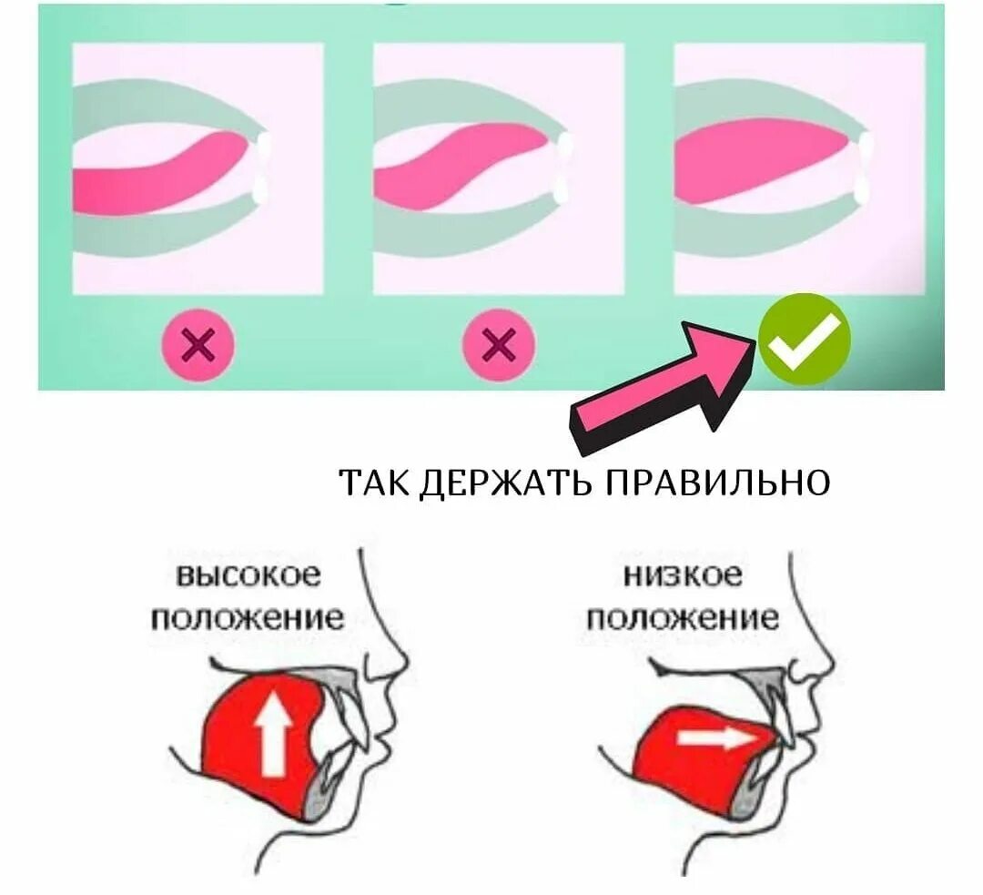 Правильное положение языка. Упражнения для правильного положения языка во рту. Правильное положение языка во рту.