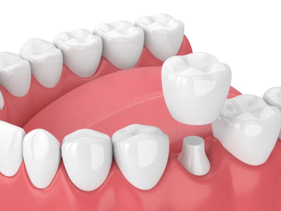 Коронки готовы. Dental crown all ceramic emax. персона серов стоматология. керамо композитные коронки.