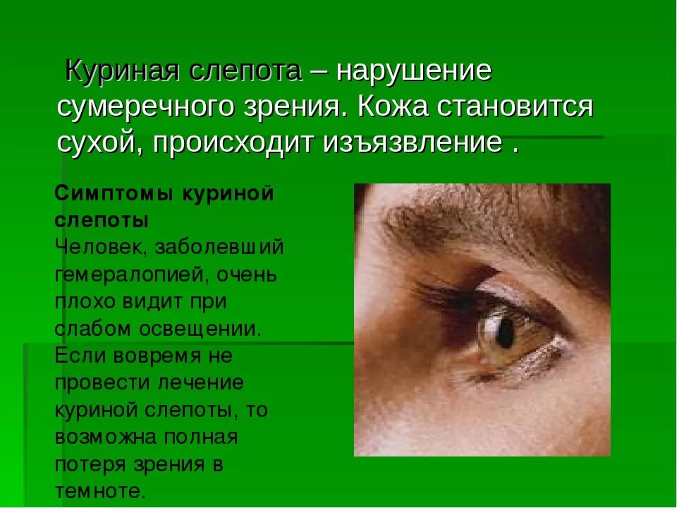 Ухудшение зрения в сумерках недостаток. Нарушение сумеречного зрения. Куриная слепота нарушение зрения.