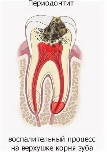 Острый апикальный периодонтит. Кариес пульпит периодонтит. Периодонтит воспаление. Гнойный периодонтит зуба.