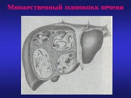 Диагностика эхинококкоза печени