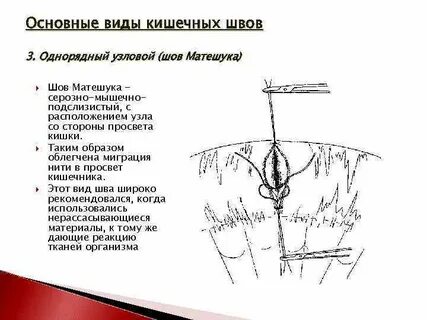 Кишечные швы топографическая анатомия