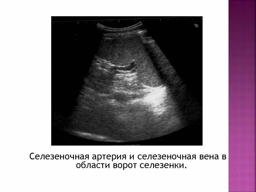 Расширение селезеночных вен. Селезеночная Вена на УЗИ норма. Селезеночная Вена УЗИ анатомия. Воротная Вена селезенки УЗИ. Селезеночная Вена на УЗИ В воротах селезенки.